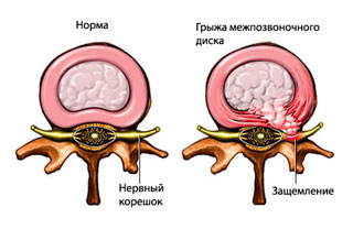Грыжа межпозвонкового диска неврология thumbnail